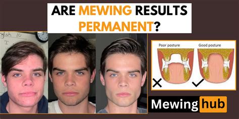 are mewing results permanent